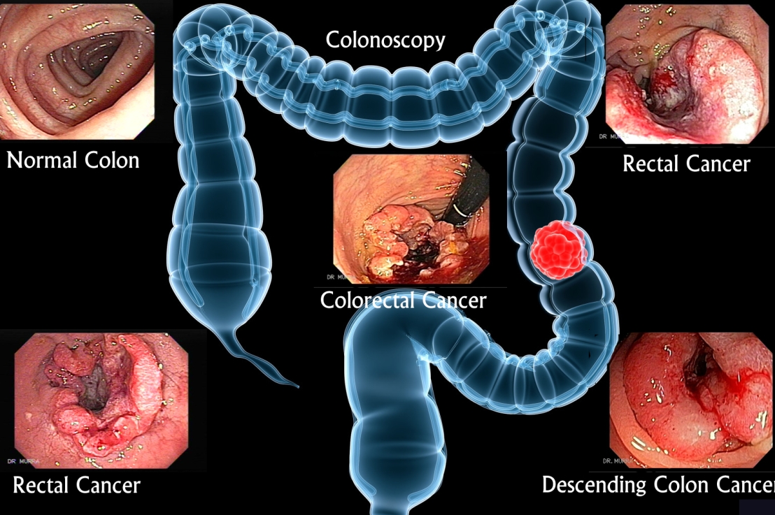Colorectal cancer illustrates how loss of a tumor suppressor gene can lead to cancer